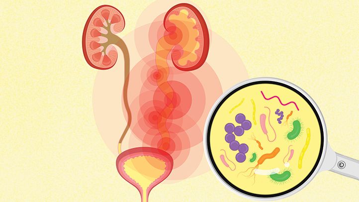 Causes of Urinary Tract Infections