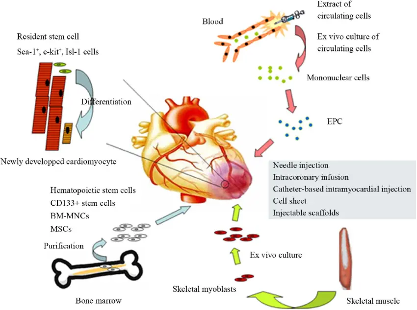 Myocardial Infaction Symptoms